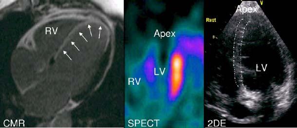 Viability (βιωσιμότητα( βιωσιμότητα) CMR, SPECT, and 2DE in a