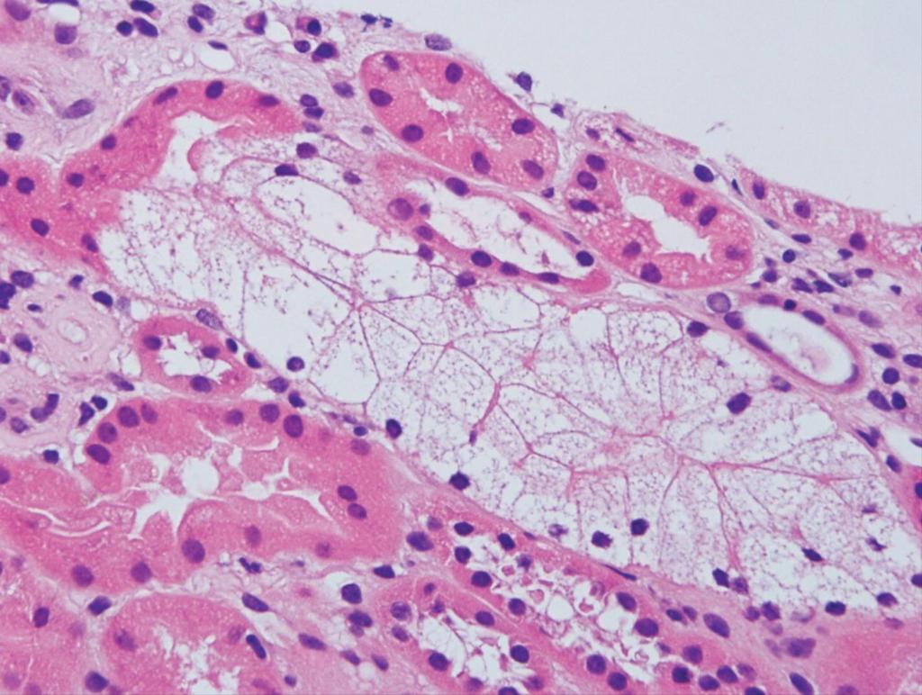 High-power view of involved renal tubule reveals marked epithelial cell swelling due to numerous tiny clear cytoplasmic vacuoles (original magnification 600).