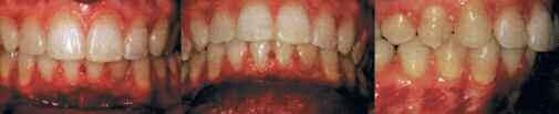 Το άνω οδοντικό τόξο είναι κάπως ευθύ στην πρόσθια περιοχή. Ο άνω δεξιός πλάγιος τοµέας βρίσκεται σε χειλική θέση κι υπάρχει µία ανωµαλία 2.5χιλ. στο κάτω οδοντικό τόξο. Εικ. 6a,b.