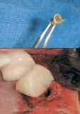 4α), και στη συνέχεια ανυψώστε το έδαφος του ιγµορείου µε ένα µεγαλύτερο χειρουργικό τρύπανο που προωθείται µόνο 1χιλ. βαθύτερα(εικ. 4b).