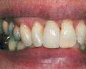 Το δόντι είχε µία διχοτοµηµένη ρίζα που το καθιστούσε µη αποκαταστάσιµο(εικ. 2). Το δόντι αφαιρέθηκε και τοποθετήθηκε ένα δόντι οδοντοστοιχίας ως προσωρινή αποκατάσταση.