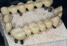 Μετά από πλήρη εξέταση και προκαταρκτική περιοδοντική θεραπεία, τα δόντια παρασκευάστηκαν και λήφθηκε ένα αποτύπωµα. Επελέγησαν τα χρώµατα των δοντιών εξατο- µικευµένα και καταγράφηκαν µε φωτογραφίες.