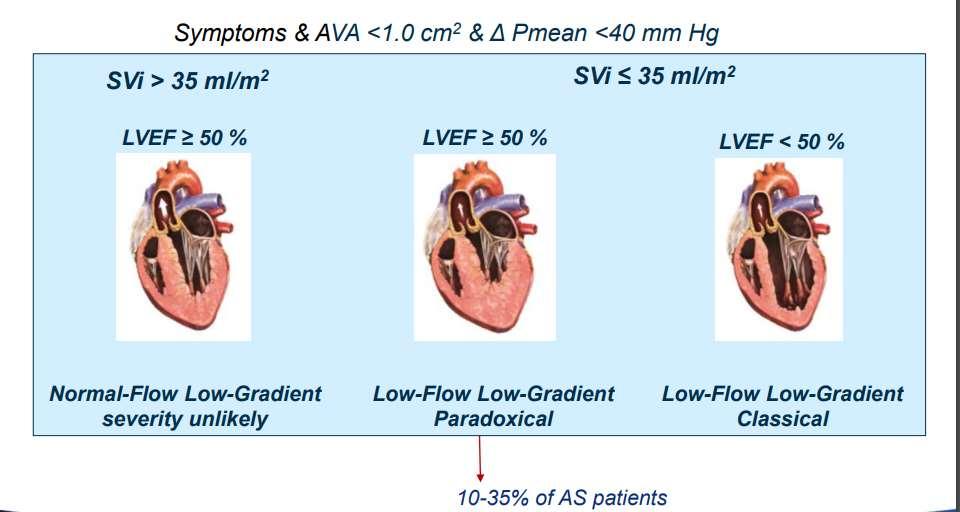 Low Gradient Aortic Valve Stenosis