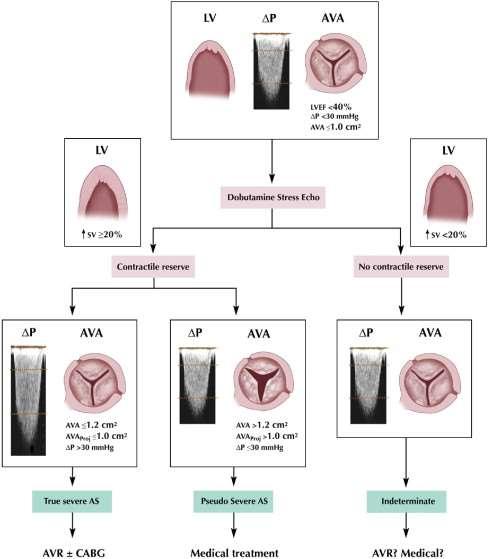 LG AS Stress Echo Stress echo Pseudosevere AS is defined by an increase to an AVA