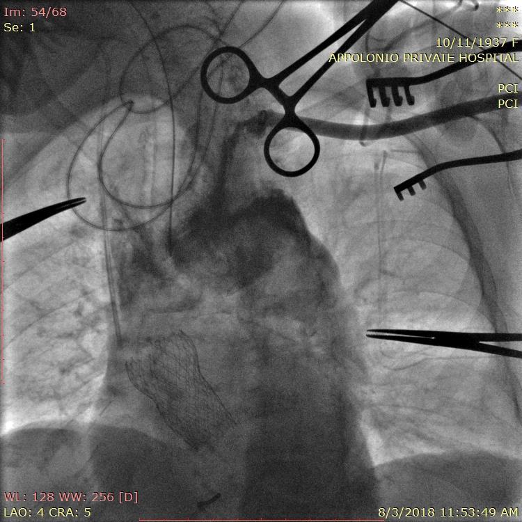 contrast injection Antegrade