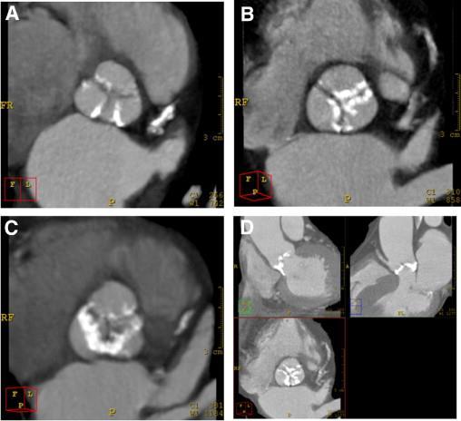 G,  JACC Cardiovasc Interv.