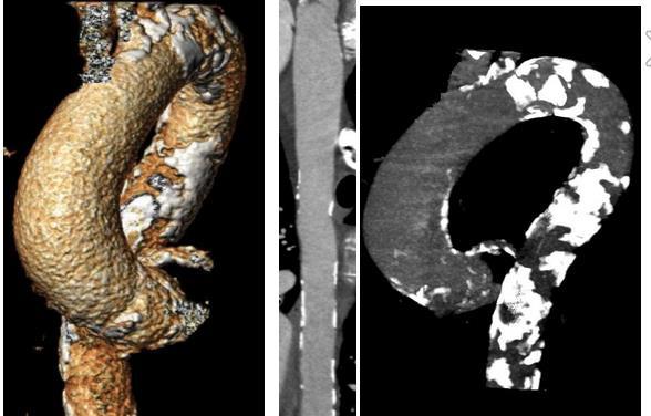 Vascular Access PATIENT SELECTION CONSIDERATIONS Physicians should consider that complex anatomical configurations increase the risk of vascular trauma; these include the following: Multiplanar