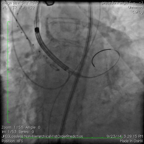 CALCIFIED AORTIC ARCH