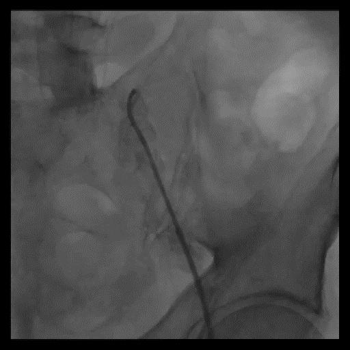 TAVI and 2 nd approach trans-radial