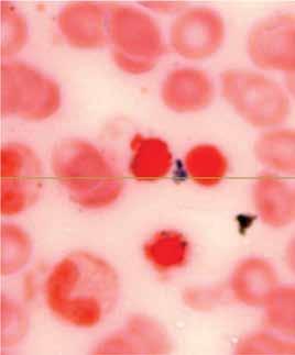 Συγγενείς μικροκυτταρικές αναιμίες οφειλόμενες σε διαταραχές μεταβολισμού του σιδήρου 281 συχνή γενετική μορφή σιδηροβλαστικής αναιμίας.
