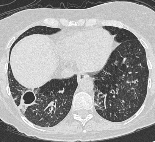 CT scan nodules
