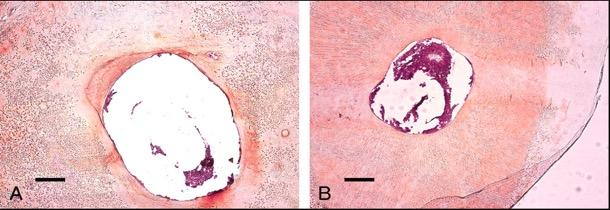 Disinfection of Root Canals with Photon-initiated Photoacoustic Streaming O. A. Peters, S. Bardsley, J. Fong, G.