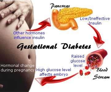 Διαβήτης Κύησης Diabetes that is diagnosed in the second or, more commonly, third trimester and is distinct from type 1 and type 2 diabetes (ADA 2016a).