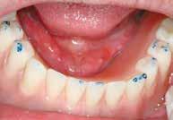 26 Ο ασθενής με τη μόνιμη επένθετη οδοντοστοιχία και την προσωρινή άνω αποκατάσταση στο στόμα. Εικ.