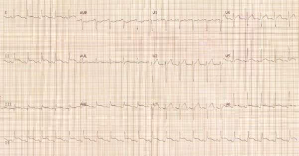 Υπάρχει ςφνδρομο Wolff Parkinson White. 2014 ESC/ESA Guidelines on non-cardiacsurgery: Eur J Anaesthesiol. 2014;31(10):517-73.