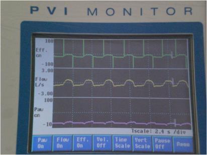 Patient-ventilator