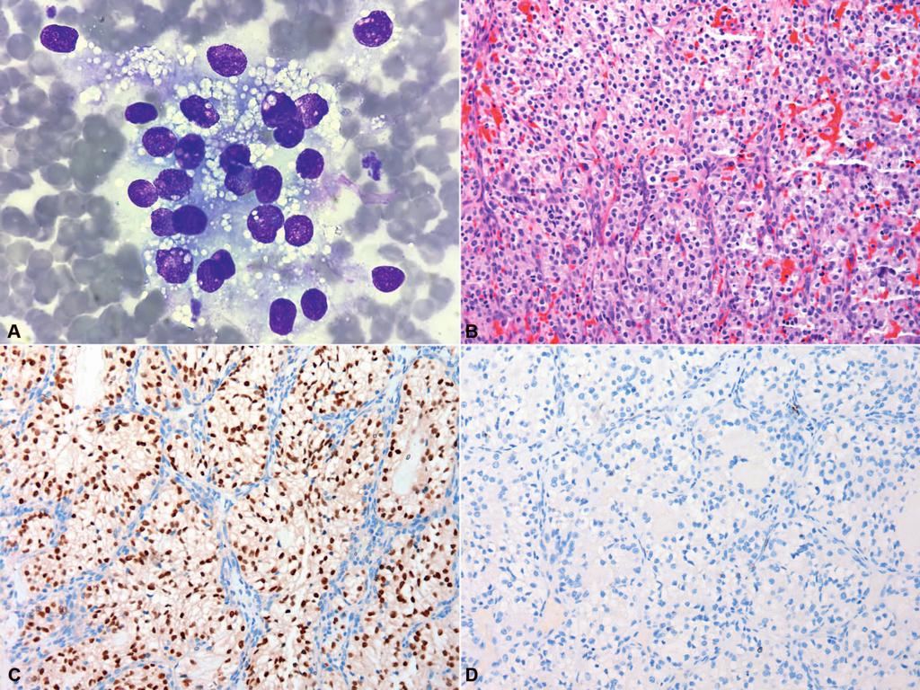 Figure 1. Metastatic renal cell carcinoma, clear cell type.