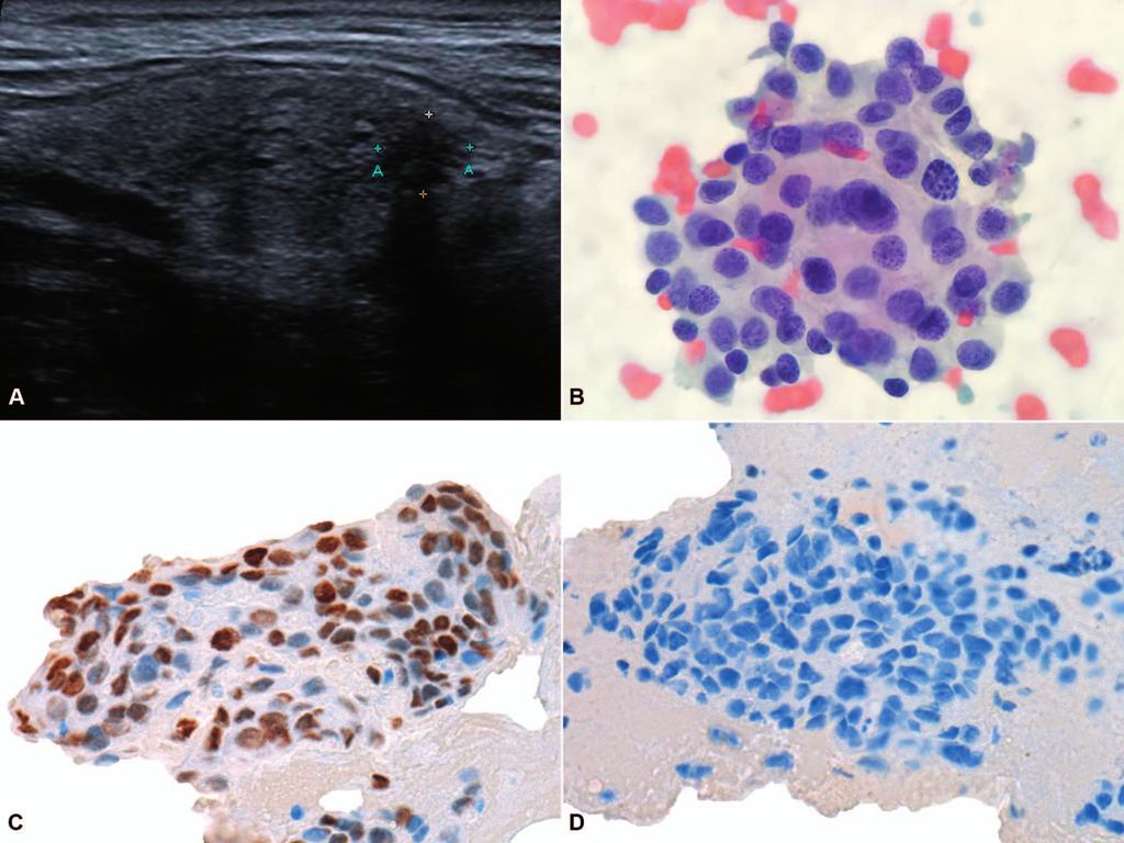 Figure 2. Metastatic ductal carcinoma of the breast. A, Solid hypoechogenic irregular nodule in the inferior third of the right lobe of the thyroid gland, with acoustic shadowing and size of 7 mm.