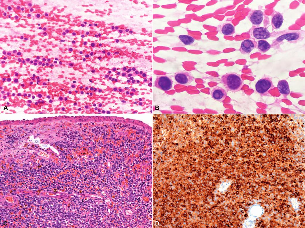 Figure 3. Metastatic malignant melanoma. A, Cellular sample constituted by discohesive malignant cells in a bloody background (smear).
