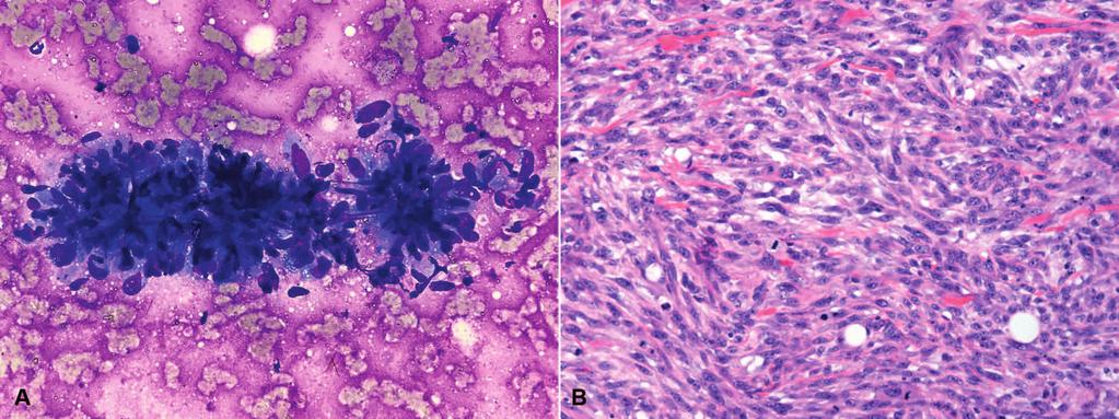 C and D, Previously resected nasal mucosa neoplasm constituted of sparsely pigmented epithelioid cells, positive for HMB45 (D), reported as mucosal melanoma (hematoxylin-eosin, original