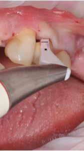 Ωστόσο, η σκόνη PLUS είναι φιλική όχι μόνο προς τους οδοντικούς ιστούς αλλά και προς τα αποκαταστατικά/ προσθετικά υλικά.