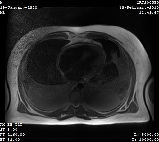 Ευρήματα CMR (2) PERICARDIAL THICKENING (SEVERAL PARTS