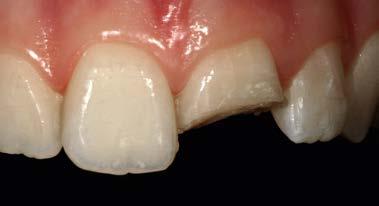 Εικόνα 7b* Η μεταλλική-κεραμική στεφάνη 21 δεν διακρίνεται ως οδοντοπροσθετική, διότι
