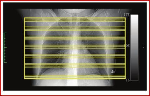 Η κλινική ένδειξη Standard HRCT vs Low Dose HRCT Κλινική ένδειξη: Διάχυτες πνευμονικές παθήσεις 120 kv, pitch:1, helical mode, image
