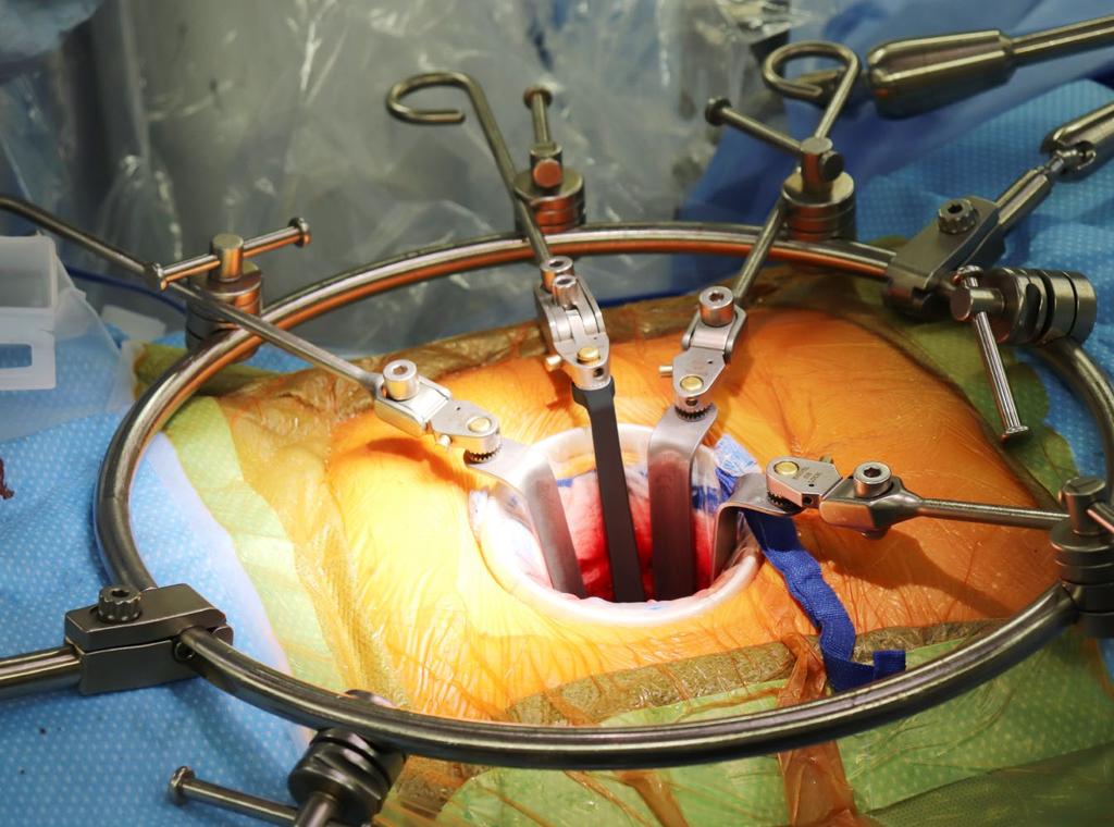 Uncompromised Exposure Thompson Techniques: ANTERIOR LUMBAR RING SYSTEM / ADVANCED MIS ALIF ACCESS Thompson s Anterior Lumbar Ring System provides a simple, safe, and