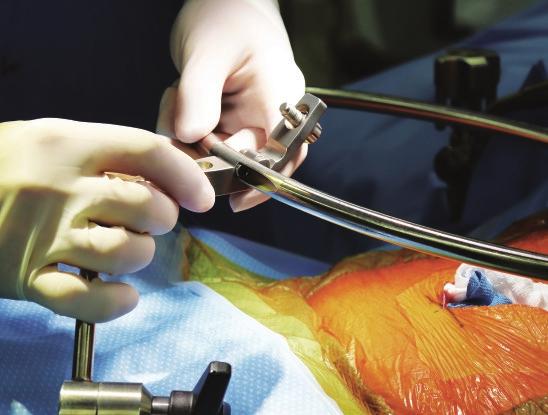 General orientation of ring should be in midline of abdomen, slightly offset to the cephalad