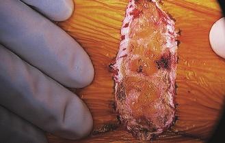 Advanced MIS Technique Head B2 D1 Toe B1 D2 Step A: Incision A knife is used to make a skin incision, usually between -6cm in length.