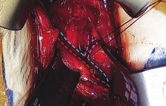 of the rectus abdominus muscle are released and the muscle is retracted laterally. For transverse incisions: The muscle is mobilized in the midline. The muscle is then retracted laterally.