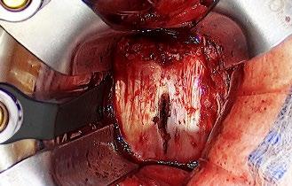 During exposure of L/5 or above, dissection is typically performed along the lateral aspect of the vessels, while dissection of the L5/S1 space typically is performed medial to the iliac vessels.
