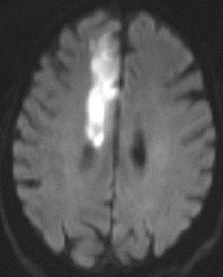 Smoking and Stroke Smoking is the cause for 12% to 14% of all deaths from stroke Risk for