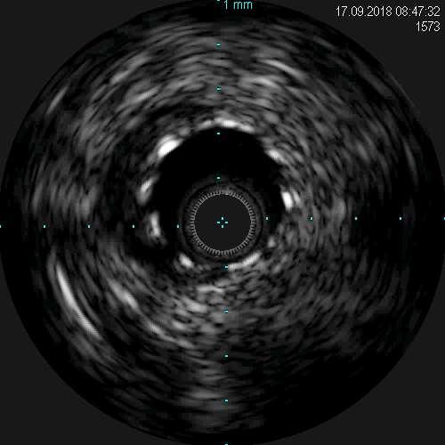 IVUS