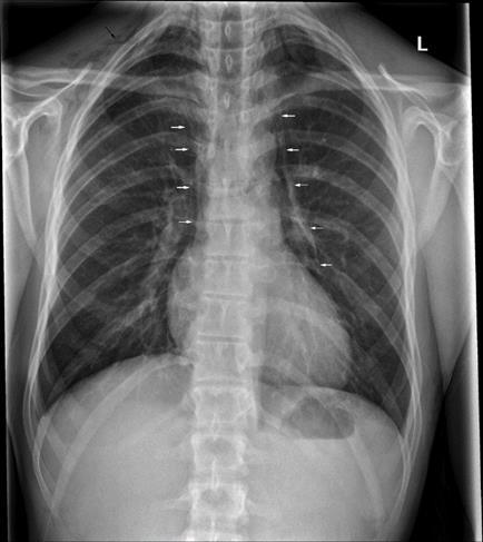 Ventilation Induced Lung Injury Barotrauma: Βαρότραυμα Η αυξημένη πίεση εντός των κυψελίδων προκαλεί τη ρήξη τους με επακόλουθο τη διαφυγή αέρα στον διάμεσο ιστό.