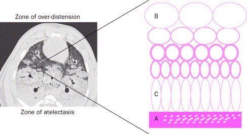 Ventilation Induced Lung