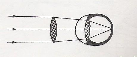 Εστίαση ακτίνων σε μυωπικό οφθαλμό Εστίαση