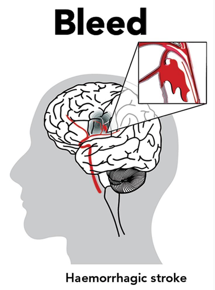 Haemorrhagic