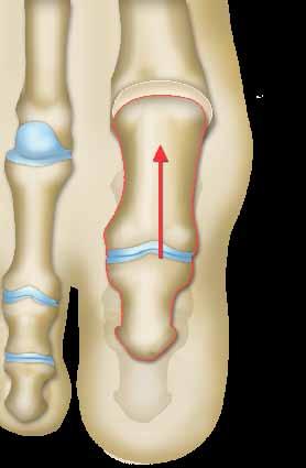 Η επέμβαση που σας προτείνουν Η βασική επέμβαση Ο χειρουργός αφαιρεί το φθαρμένο χόνδρο και εξομαλύνει τις προεξοχές του μεταταρσίου και της φάλαγγας, προχωρώντας ακόμα και στην αφαίρεσή τους.