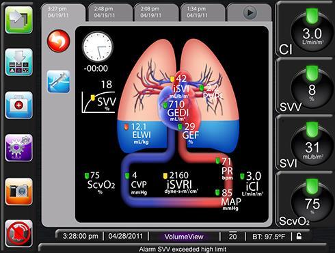 Extravascular lung water (EVLW) EVLW: Ο εξω-αγγειακός όγκος ύδατος στους πνεύμονες Υπολογίζεται με την μέθοδο της διαπνευμονικής θερμοαραίωσης Παρουσιάζει πολύ καλή συσχέτιση με την