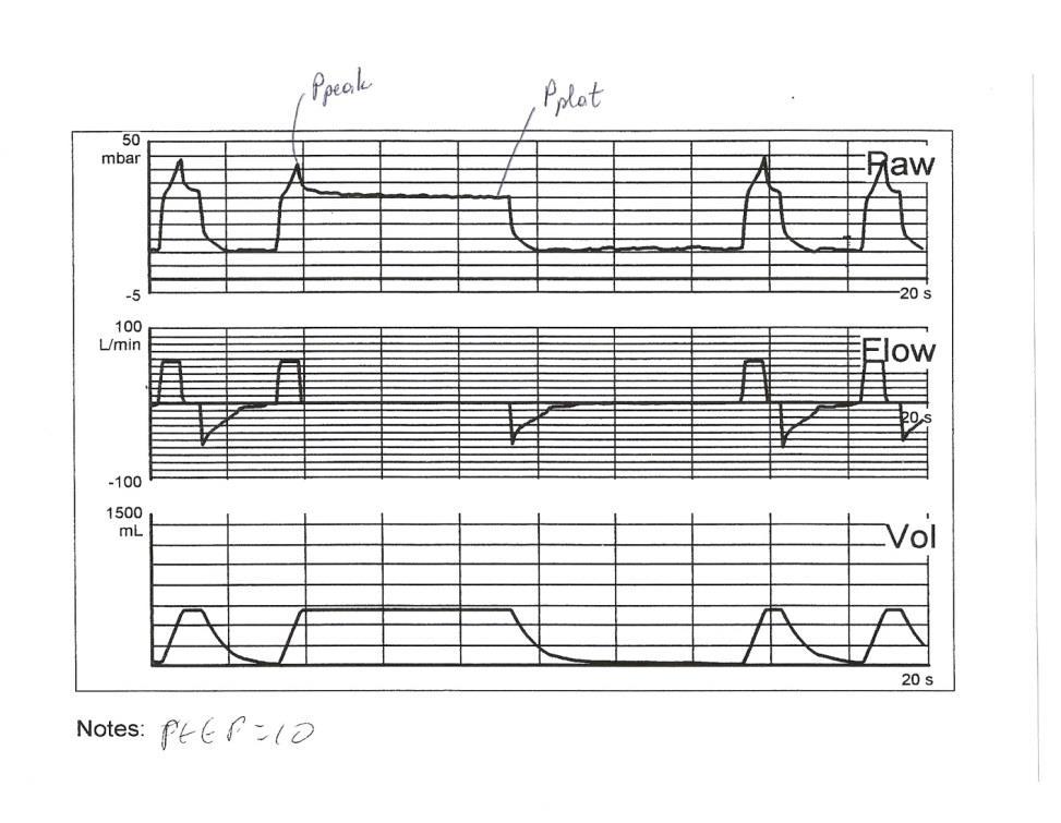 Η Ελαστικότητα (Elastance) Est,rs=ΔP/ΔV cm H