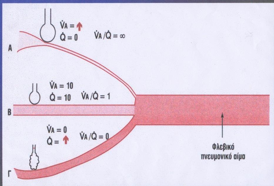 Οξυγόνωση Εκτίμηση της ανισοτιμίας V/Q ΔA-aO 2 = PAO 2 -PaO 2 PAO 2 = PiO 2 PaCO