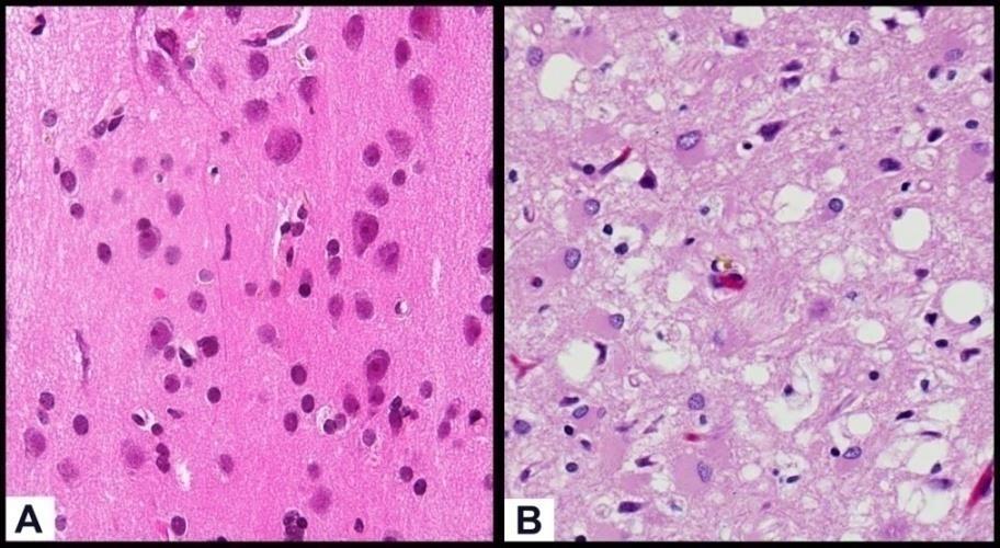 Prions μικρά πρωτεϊνικά, λοιμώδη σωμάτια (< 5 nm) χωρίς νουκλεϊκό οξύ κωδικοποιούνται από κυτταρικά γονίδια 9 νευρολογικά νοσήματα σε ζώα γενετικό υπόβαθρο: σε οικογένειες Nόσος των τρελών αγελάδων: