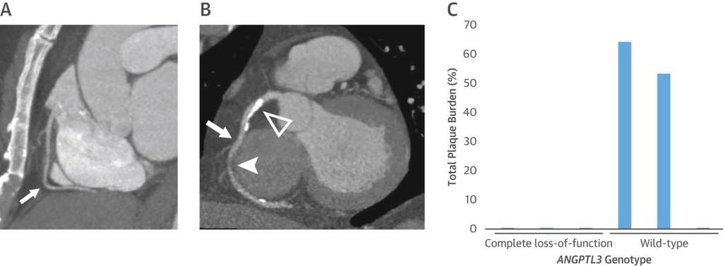 ANGPTL3 και αθηρωματική πλάκα Coronary Computed Tomography Angiography in Humans With and