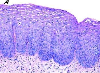 CIN 1 (cervical intraepithelial neoplasia