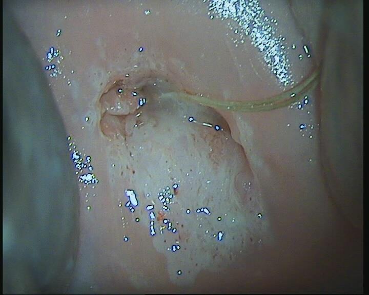 CIN 2-3 (cervical intraepithelial neoplasia grade 2-3): Παθολογοανατομικός όρος - Βιοψία