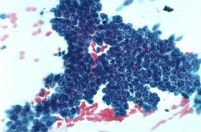 Organization Chart Title Atypical Glandular Cells ACG-NOS Risk of high grade lesion 10-40% ACGfavor neoplasia Risk of high grade lesion >90% AIS Risk of high grade glandular lesion>95%