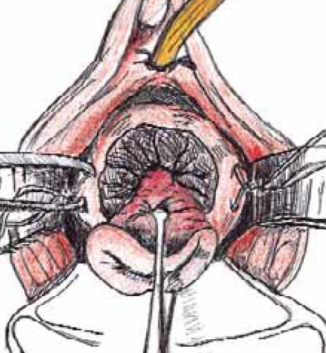 Lugol application Circular incision lateral to the ΤΖ