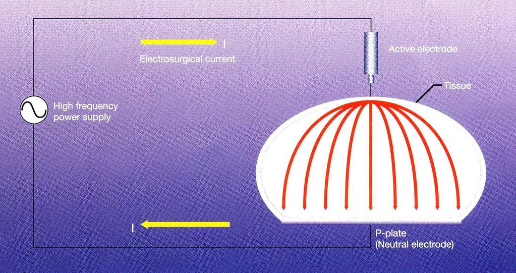 Ηλεκτοχειρουργικό ρεύμα Ενεργό ηλεκτρόδιο ιστός